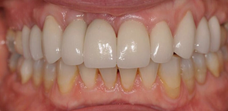 dr william kay prosthodontist boca ration fl smile gallery after
