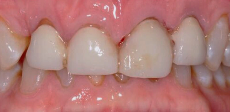 dr william kay prosthodontist boca ration fl smile gallery after